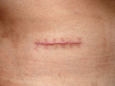 Read more about the article Promising Results for Scar Treatments