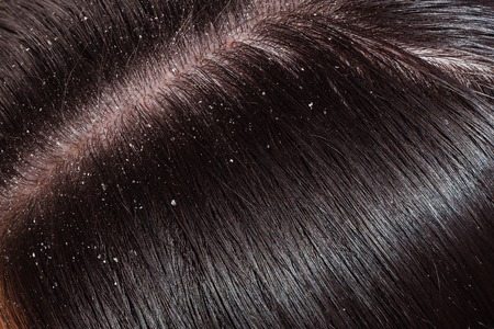 You are currently viewing Scalp Conditions: Dandruff