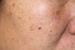 Read more about the article A Primer on Skin Hyperpigmentation